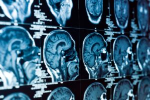 TBI lawyer Albany, NY